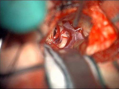 Arteriual compression of the left trigeminal nerve