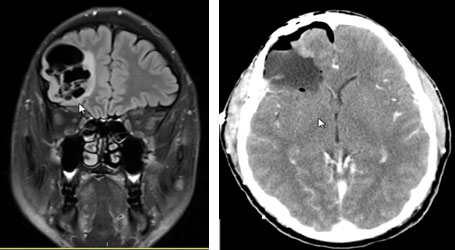 Dysembryoplastic Neuroepithelial Tumor caused patient lifelong seizures