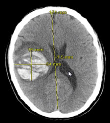 glioblastoma multiforme that caused headaches and speech issues