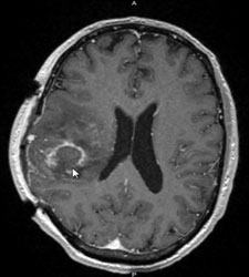 glioblastoma multiforme initial CT scan performed after 1 week history of headache