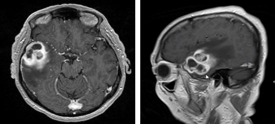 glioblastoma multiforme that caused headaches and behavior changes