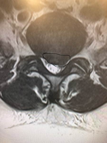 MRI (axial view) showing the large herniated disc (thin black outline) extending  into the spinal canal.