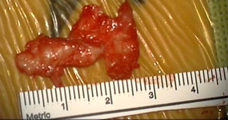 Large piece of herniated disc that was compressing nerve root is removed from the spinal canal.  This large fragment was 2.5 cm in length.