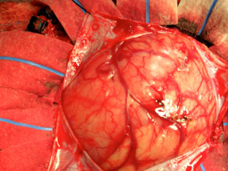 Mixed Oligodendroglioma-Astrocytoma patient's brain is under pressure