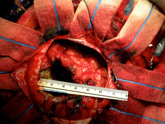 After microsurgical resection patient's brain is visibly decompressed