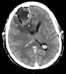 postop CT scan Mixed Oligodendroglioma-Astrocytoma patient
