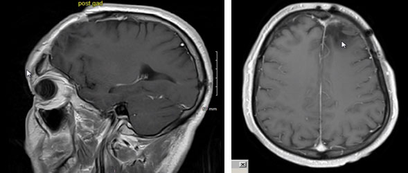 Oligodendroglioma patient 7 years after treatment